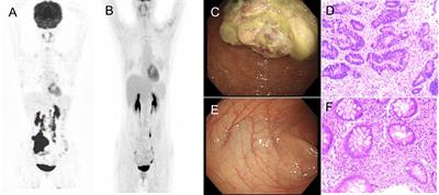 Case report: A case of complete clinical response in a patient experiencing high microsatellite instability unresectable colon cancer being treated with a PD-L1 inhibitor after interstitial pneumonia